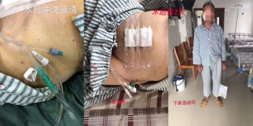 我院顺利地为高龄前列腺增生加巨大膀胱结石患者 解决多年疾病困扰